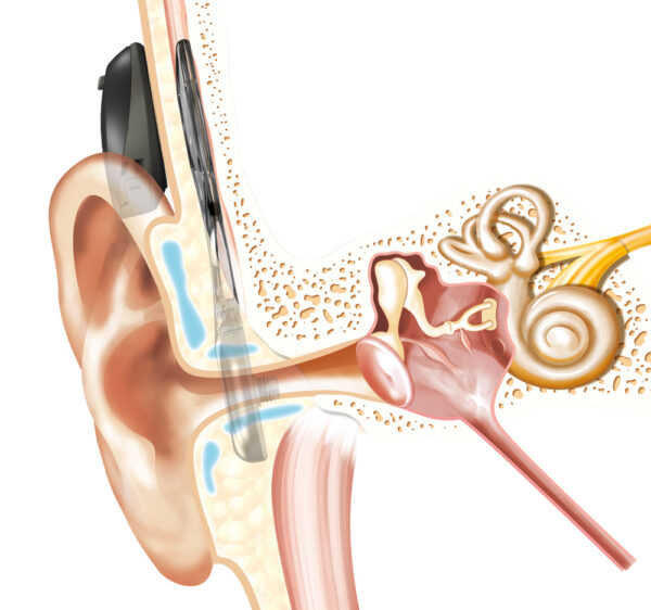 Osia_Hearing_head_clean-600×562